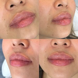 lip filler results in Chino, California