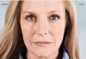 Image of face with sculptra showing results possible from Rumi in Chino California