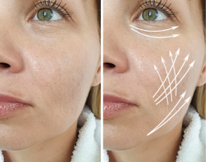 womens face one one side and on the other with lines showing where she can get ez gel treatment at Rumi in Chino california