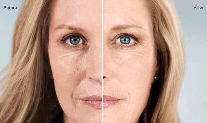 woman's face with half side before sculptra and other half after