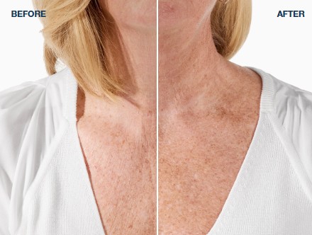 before after Radiesse