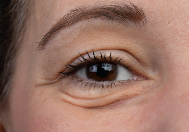 EZ gel treatment for undereye wrinkles at Rumi in Chino, California